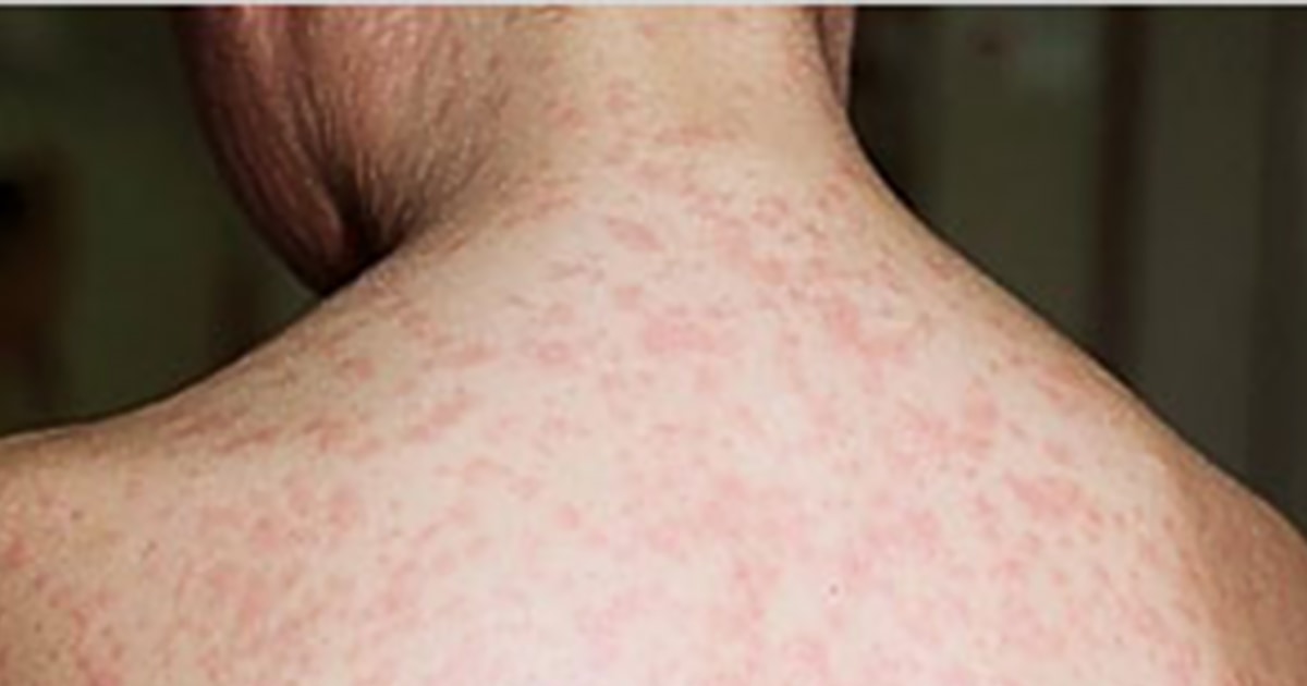 The CDC warns that measles eradication is "in danger" in the United States