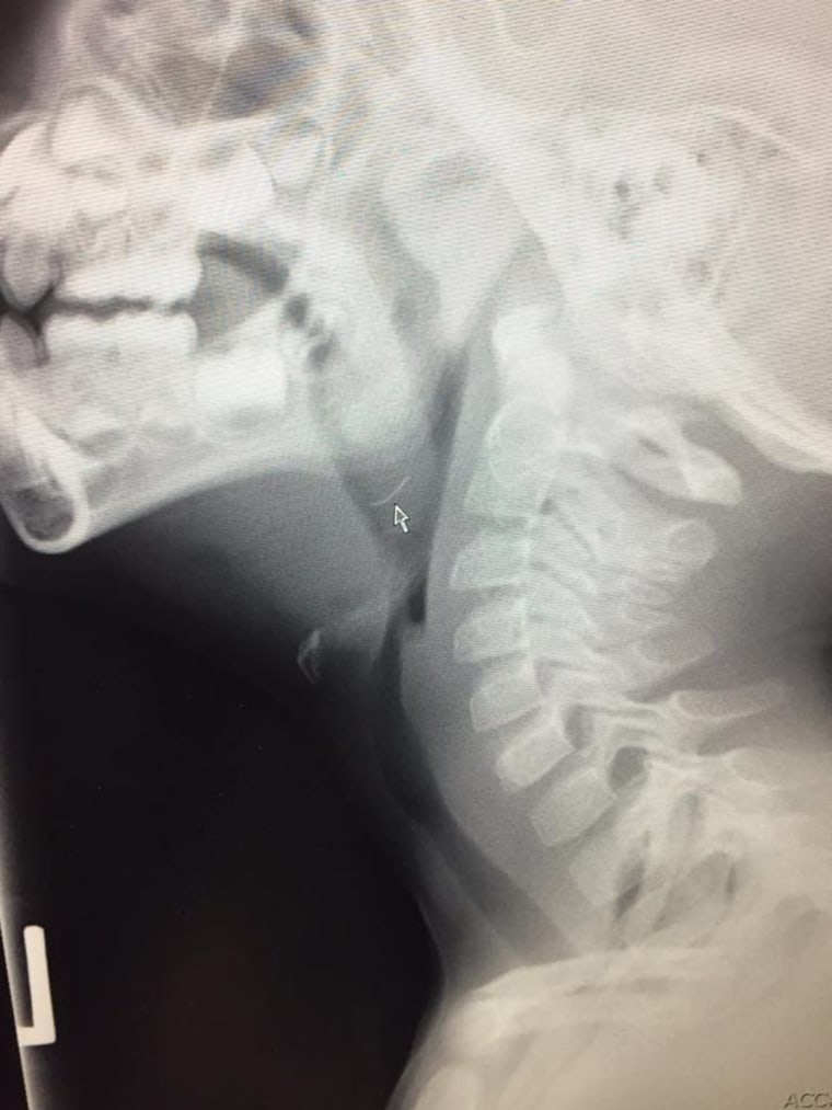 An x-ray of 4-year-old Oliver Schenn (not the patient treated by Dr. Martin) shows the metal bristle lodged in his throat.