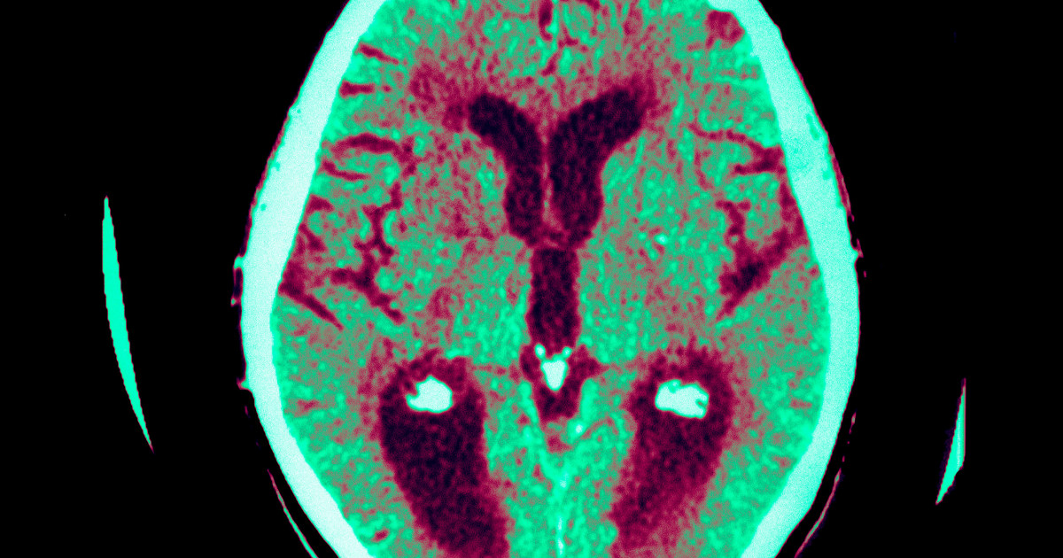 Scientists who study Alzheimer's say it is likely that a brain device can delay the symptoms