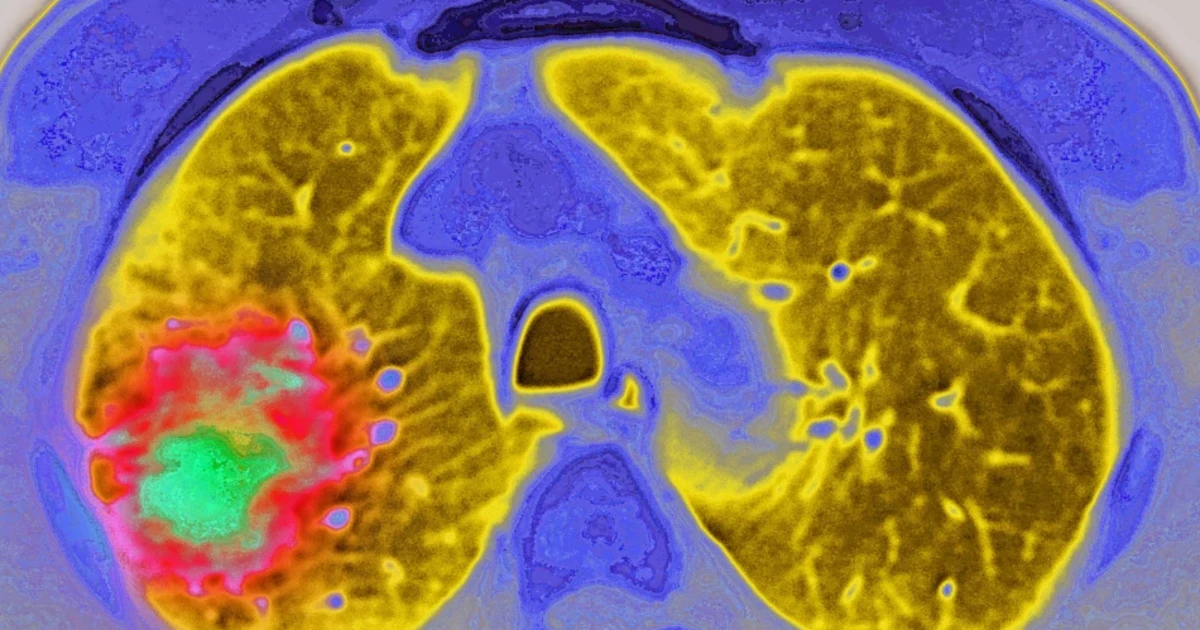 GLP-1 weight loss drugs may also reduce the risk of cancer progression