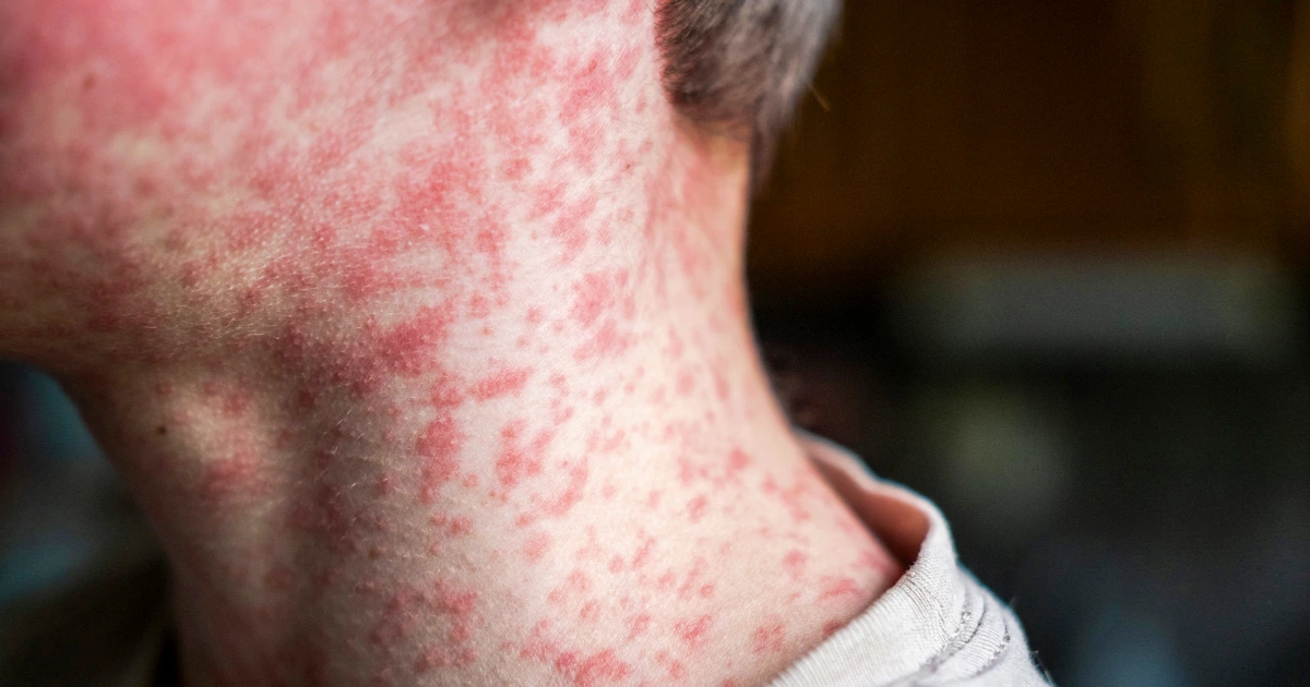 With measles cases on the rise, Pennsylvania doctors see the effects the virus can have on children